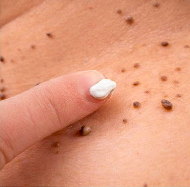 Warts Remover