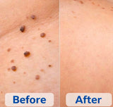 Warts Remover