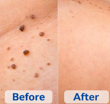 Warts Remover