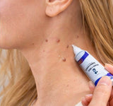 Warts Remover